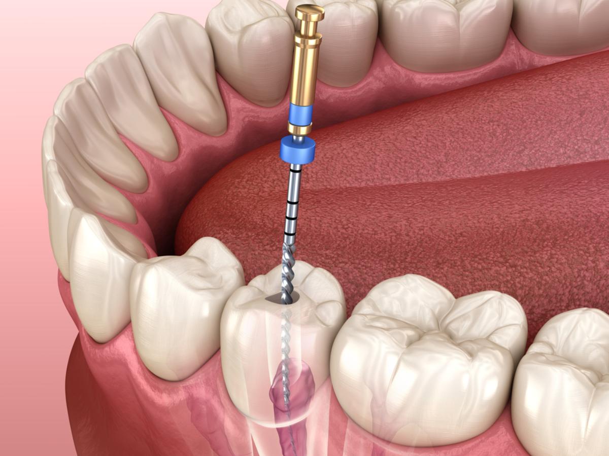 Endodoncia